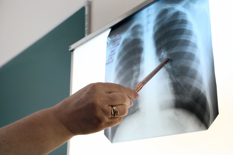 Специалисты рассмотрели особенности лечения туберкулеза в Беларуси
