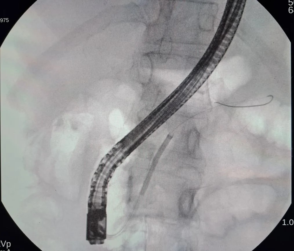 Инновационные технологии дробления и удаления конкрементов поджелудочной железы