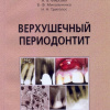 Верхушечный периодонтит