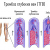 НПК о лечении и профилактике глубоких венозных тромбозов